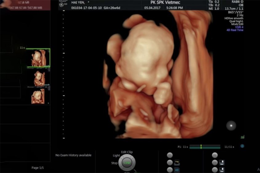 Hình ảnh siêu âm thai nhi 24 tuần tuổi