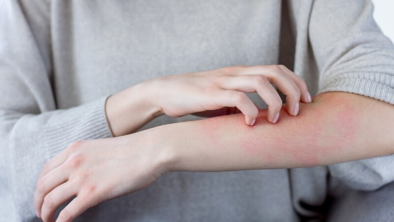 Phát ban, ngứa là tác dụng phụ có thể gặp khi dùng hoạt huyết dưỡng não