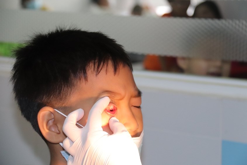 Đau mắt đỏ hay còn gọi là viêm kết mạc là bệnh về nhiễm trùng mắt