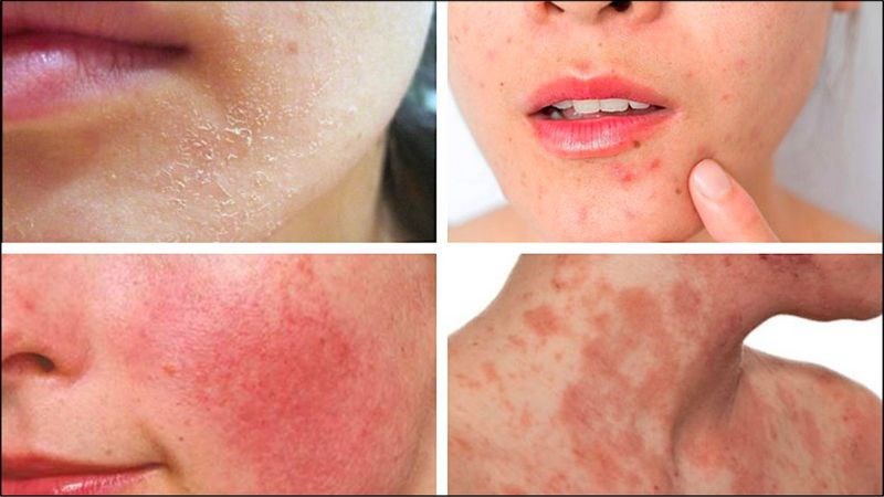 Các tác hại của nước mưa đến làn da