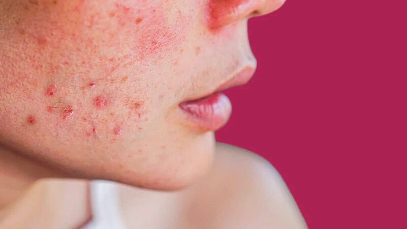 Nổi mẩn đỏ và ngứa là những biểu hiện thường gặp ở làn da dễ kích ứng