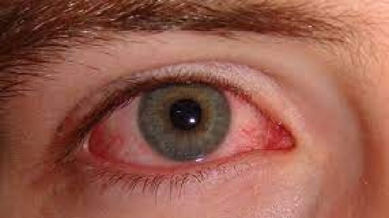 Kích ứng mắt với những biểu hiện đỏ, sưng ngứa vùng quanh mắt