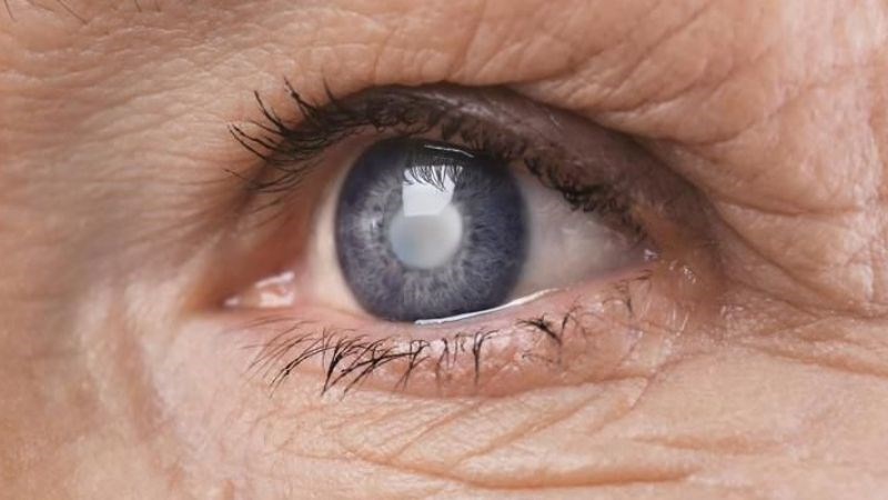 Nhỏ mắt sai cách có thể gây đục thuỷ tinh thể