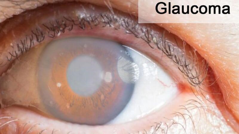 Thuốc nhỏ mắt có thể gây glaucom