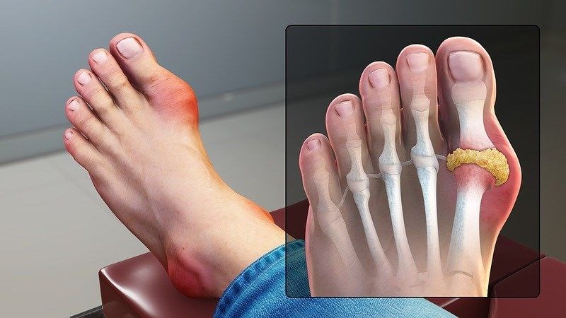 Những người bị bệnh gout không nên ăn súp cua 