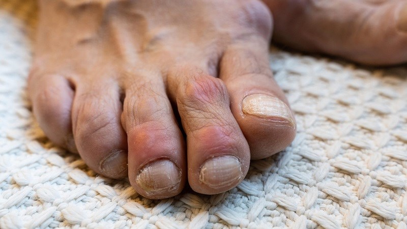 Viên Gout Tâm Bình dùng cho người có nồng độ acid uric máu cao, bị gout cấp và mạn tính