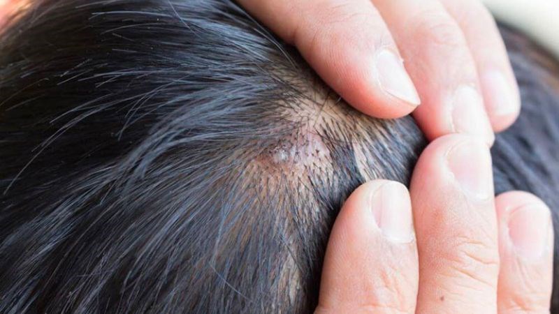 Một số loại chống nắng có thể khiến da đầu nổi mụn