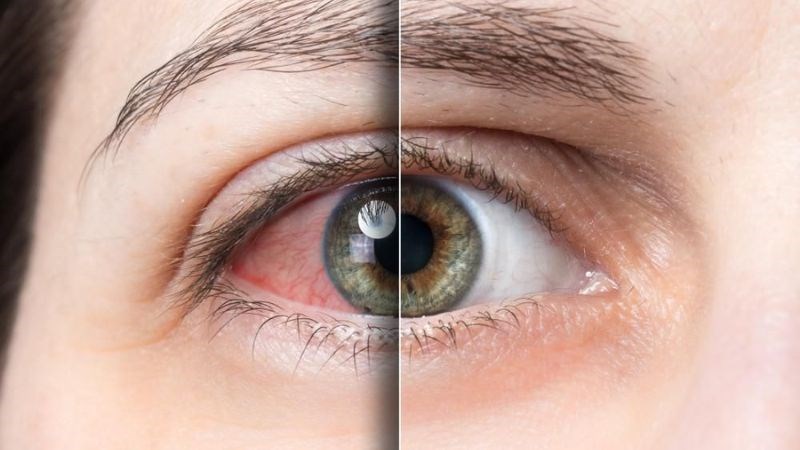 Khô mắt do thiếu vitamin A có thể là nguyên nhân dẫn đến mù lòa