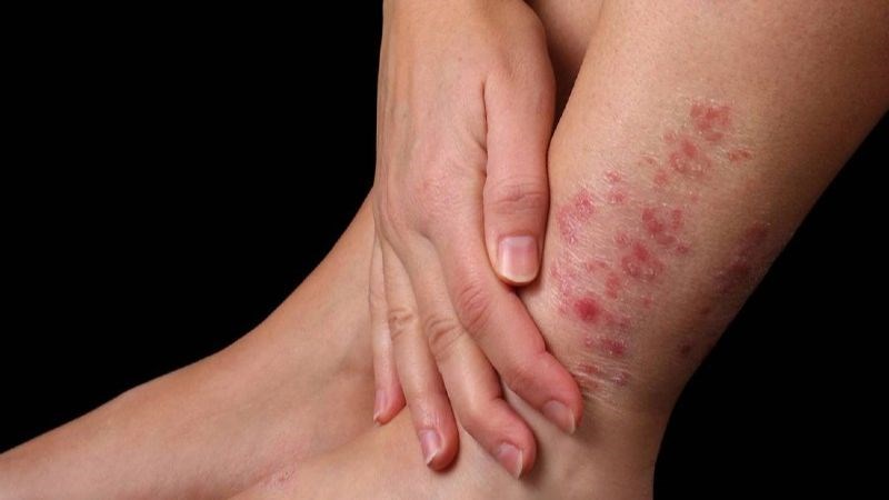 Thiếu hụt vitamin A có thể làm tăng nguy cơ mắc các bệnh về da 