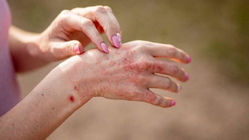 Viêm da cơ địa là thể bệnh thường gặp nhất của chàm