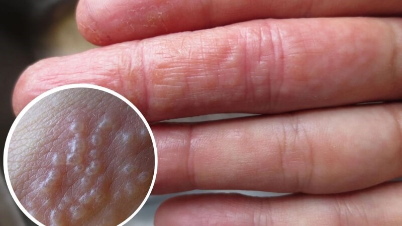 Cần gặp bác sĩ nếu tình trạng nổi mụn nước ngày càng nặng lên
