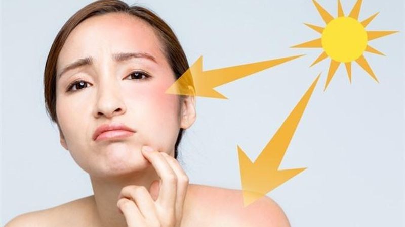 Người có da dễ bị cháy nắng nên sử dụng kem chống nắng có chỉ số SPF cao