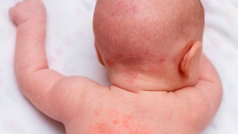 Dị ứng thực phẩm ở trẻ có thể dẫn đến phát ban da