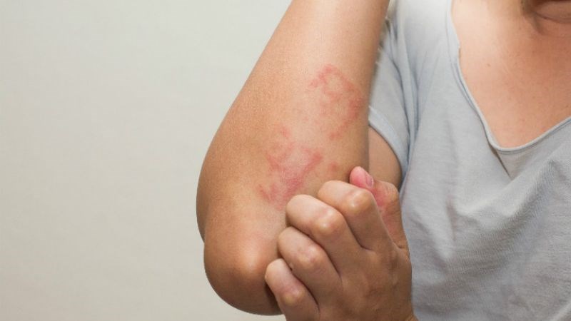 Người có tiền sử dị ứng đối với trứng hoặc sản phẩm từ trứng nên tránh ăn trứng cút
