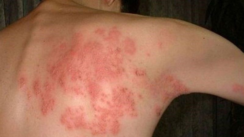 Bệnh zona thần kinh là một bệnh nhiễm trùng do virus Varicella-zoster gây ra Bệnh zona thần kinh là một bệnh nhiễm trùng do virus Varicella-zoster gây ra