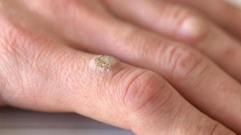 Mụn cóc là một loại u lành tính trên da do virus HPV gây ra Mụn cóc là một loại u lành tính trên da do virus HPV gây ra