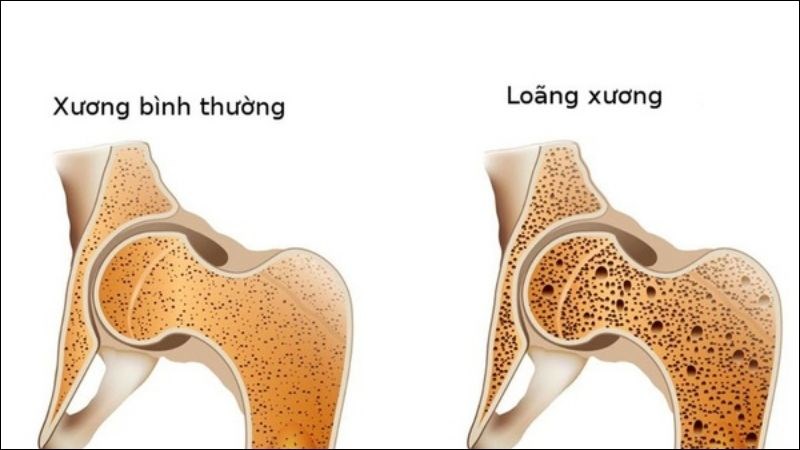 Tỏi giúp giảm nguy cơ loãng xương ở phụ nữ lớn tuổi
