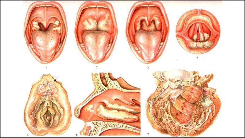 Vi khuẩn bạch hầu làm chết các mô, gây ra 