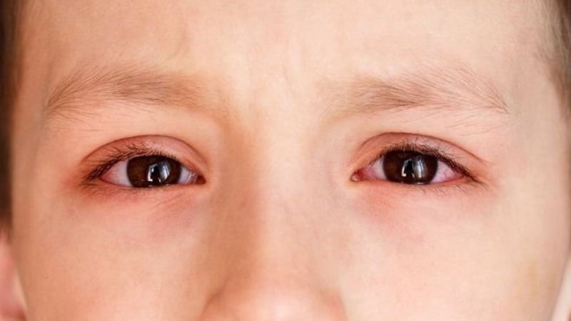 Đau mắt đỏ là tình trạng viêm nhãn cầu và kết mạc của mắt Đau mắt đỏ là tình trạng viêm nhãn cầu và kết mạc của mắt