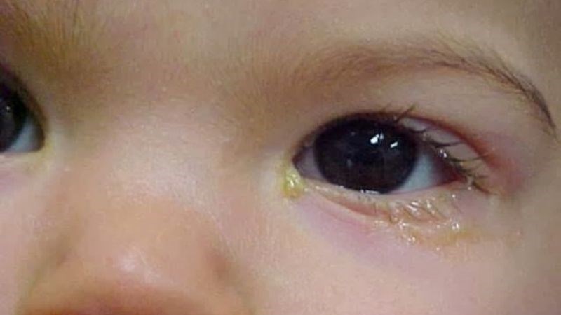 Bệnh lý tắc tuyến lệ ở trẻ gây đau mắt đỏ ở trẻ Bệnh lý tắc tuyến lệ ở trẻ gây đau mắt đỏ ở trẻ