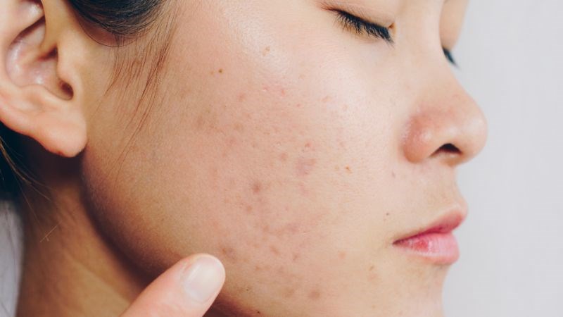 Sử dụng đều đặn vitamin E có thể làm mờ các vết tối màu trên da một cách hiệu quả Sử dụng đều đặn vitamin E có thể làm mờ các vết tối màu trên da một cách hiệu quả