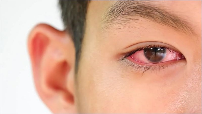 Đau mắt đỏ là một bệnh lý viêm nhiễm ở mắt