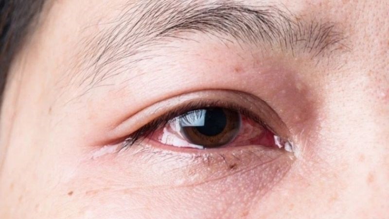 Chảy nước mắt, lòng trắng mắt màu đỏ là triệu chứng của đau mắt đỏ