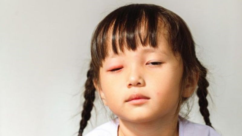 Bệnh đau mắt đỏ l&agrave; bệnh nhiễm tr&ugrave;ng về mắt kh&aacute; phổ biến ở trẻ em