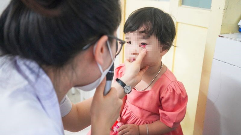 Bố mẹ cần theo d&otilde;i t&igrave;nh mắt của trẻ thường xuy&ecirc;n để ph&ograve;ng ngừa c&aacute;c biến chứng