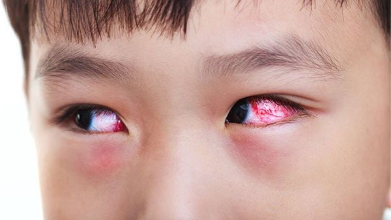 C&aacute;c chất g&acirc;y dị ứng lọt v&agrave;o mắt của c&oacute; thể l&agrave;m trẻ bị đau mắt đỏ