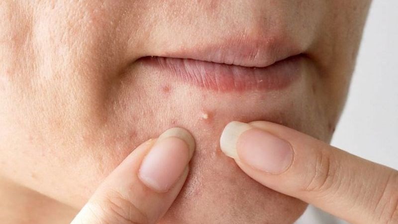 Mặt nạ chứa vitamin C có tính kháng viêm nên hỗ trợ trị mụn