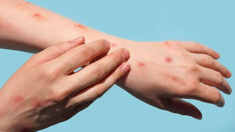 Những nốt phát ban trên tay, chân là triệu chứng cơ bản của bệnh đậu mùa khỉ