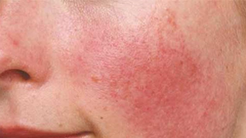 Ngưng sử dụng thuốc khi gặp các tình trạng bất thường