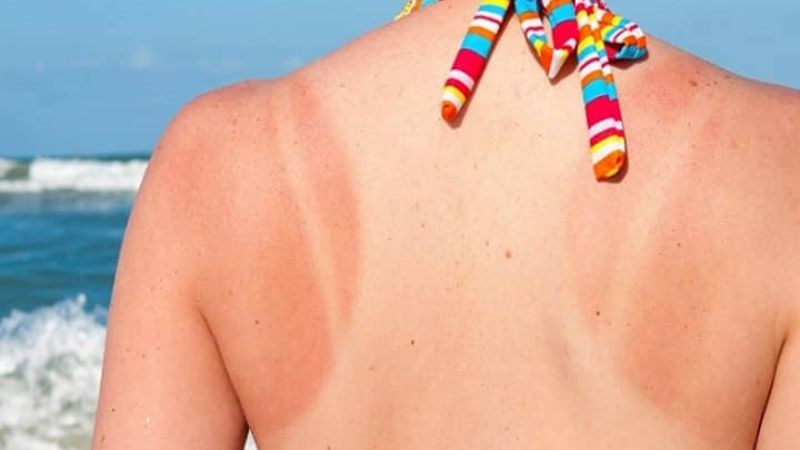 Vitamin E giúp làm dịu da bị cháy nắng, cải thiện tình trạng sạm đen