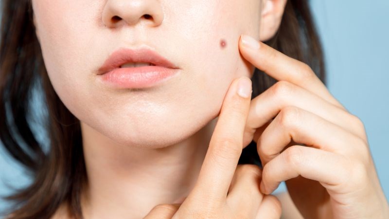 Vitamin E có tác dụng chống oxy hóa giúp cải thiện tình trạng sẹo