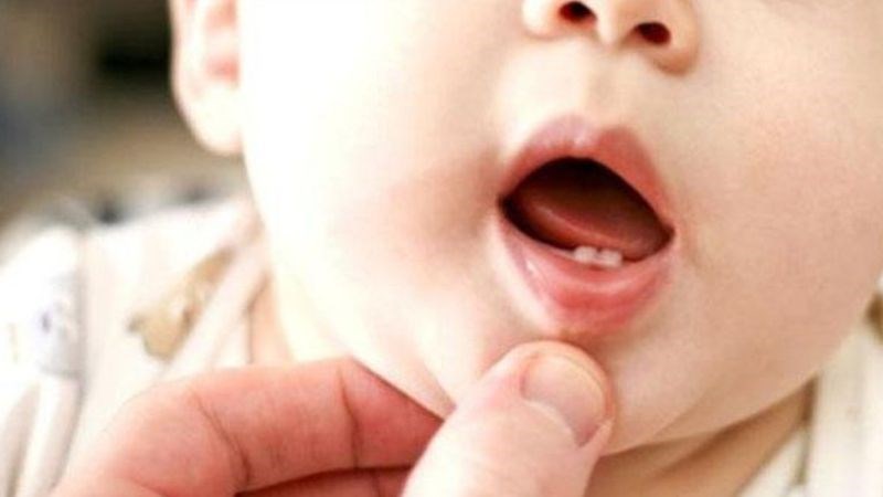 Mọc răng là một trong những nguyên nhân gây sốt ở trẻ, thường kéo dài 1-3 ngày