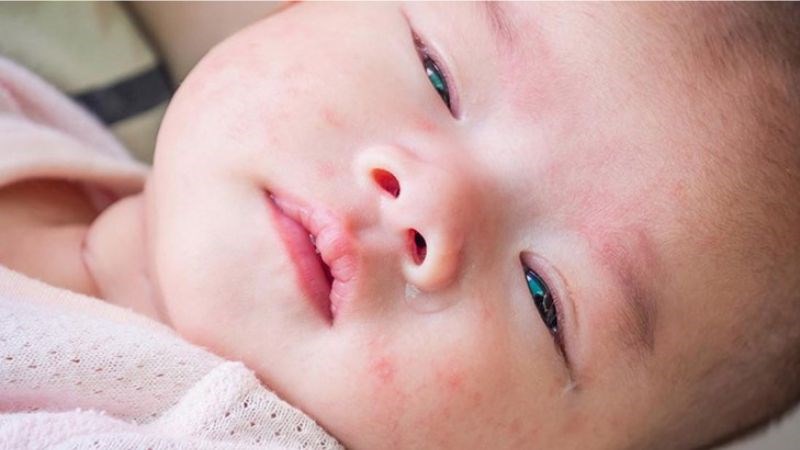 Phát ban là dấu hiệu sốt nguy hiểm, bố mẹ nên đưa trẻ đến bác sĩ sớm nhất