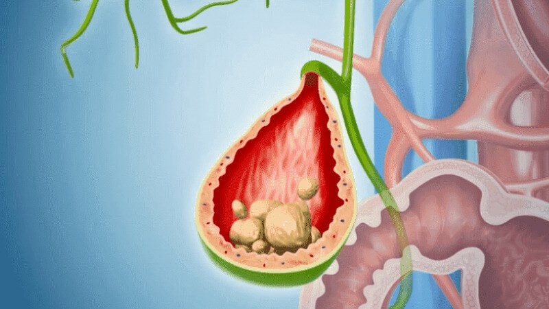 D-limonene trong vỏ chanh có thể hòa tan sỏi mật