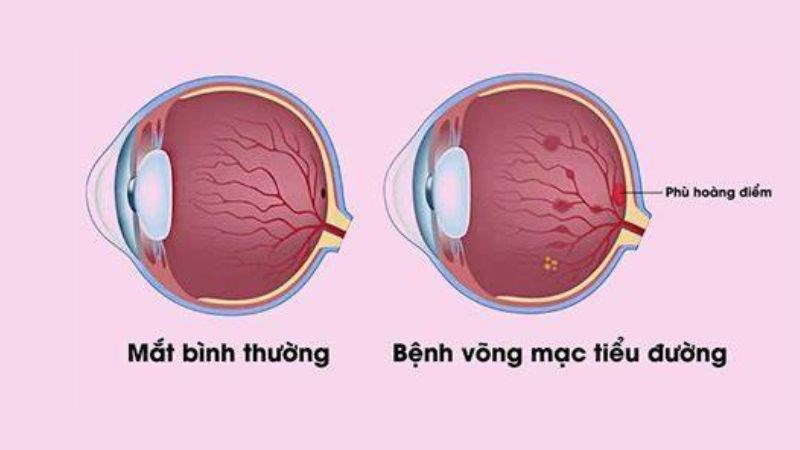 Phù hoàng điểm gây ra bởi tình trạng vỡ các mạch nhỏ ở đáy mắt