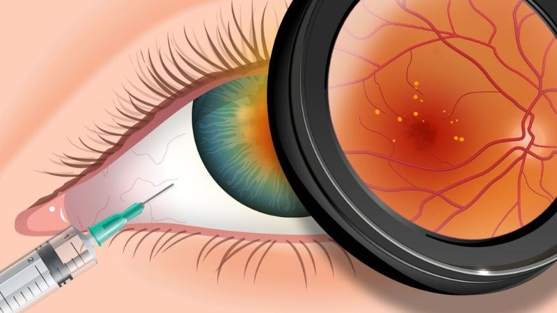 Bác sĩ thực hiện thủ thuật tiêm thuốc chống tăng sinh mạch vào mắt người bệnh