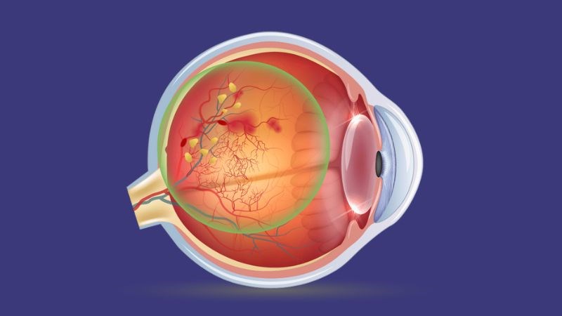 Thoái hóa điểm vàng gây giảm thị lực vĩnh viễn