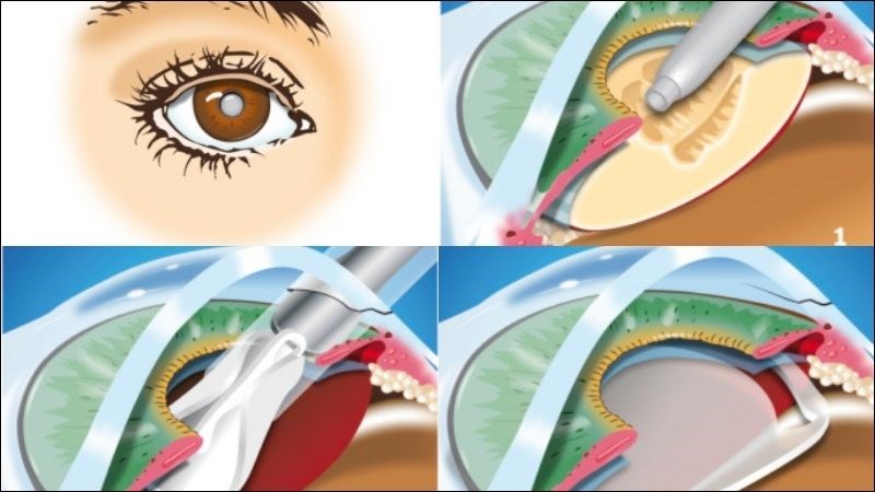 Phẫu thuật thay thủy tinh thể chỉ định trong trường hợp đục thủy tinh thể gây ảnh hưởng thị lực