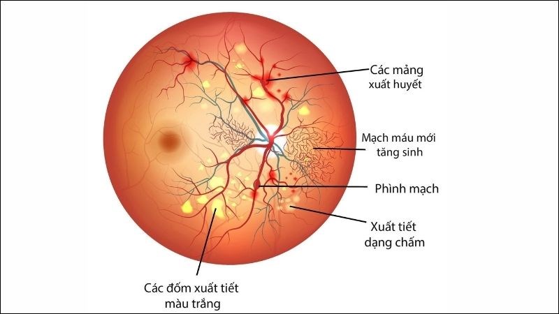 Bệnh võng mạc đái tháo đường gây tình trạng xuất huyết và tăng sinh mạch máu mới