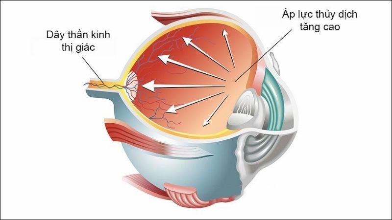 Tăng nhãn áp gây chèn ép dây thần kinh thị giác dẫn đến nhìn mờ và đau đầu dữ dội