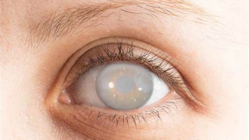 Tăng sorbitol trong bệnh đái tháo đường dẫn đến đục thủy tinh thể