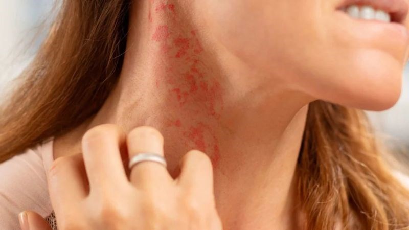 Nổi mẩn ngứa, phát ban là một trong những triệu chứng thường gặp khi bị dị ứng