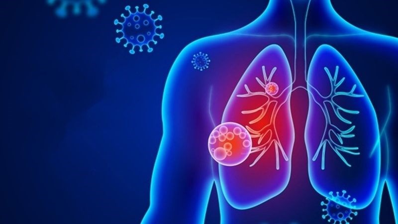 Cúm A có thể làm xuất hiện tình trạng viêm phổi nặng