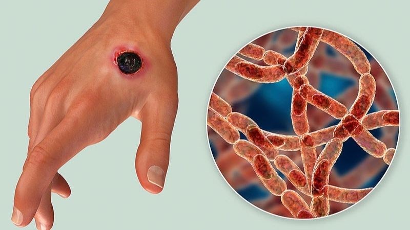 Bệnh Whitmore gây nên những vết loét trên da