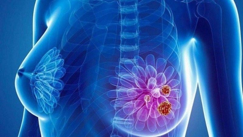 Ung thư vú nếu phát hiện và điều trị sớm tỷ lệ chữa khỏi gần như tuyệt đối