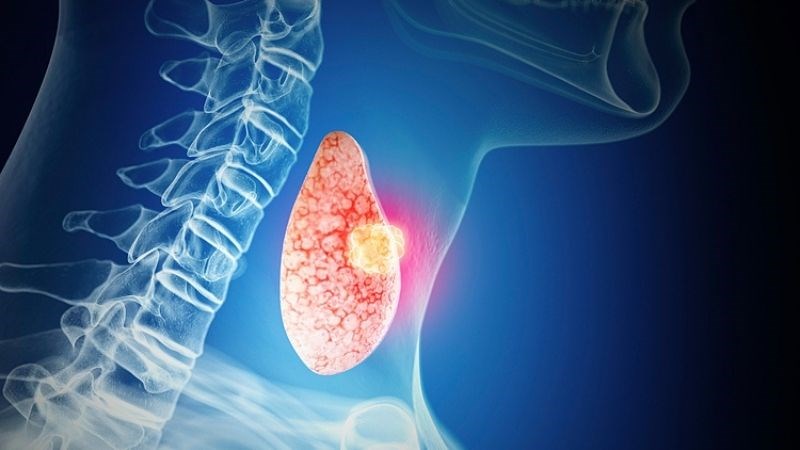 Ung thư tuyến giáp phát triển chậm hơn những loại khác